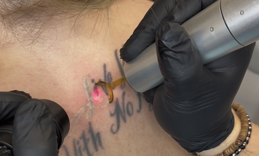 Image 3: Up to 40% Off on Tattoo Removal at Clarity Tattoo Removal