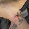 Image 4: Up to 40% Off on Tattoo Removal at Clarity Tattoo Removal
