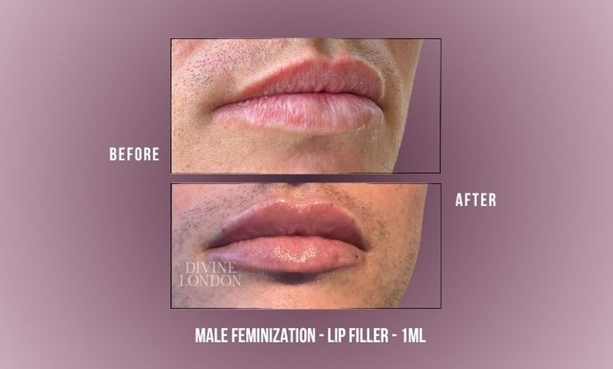 Image 5: Up to 71% Off on Injection - Dermal Filler at Divine Aesthetics Clinic London