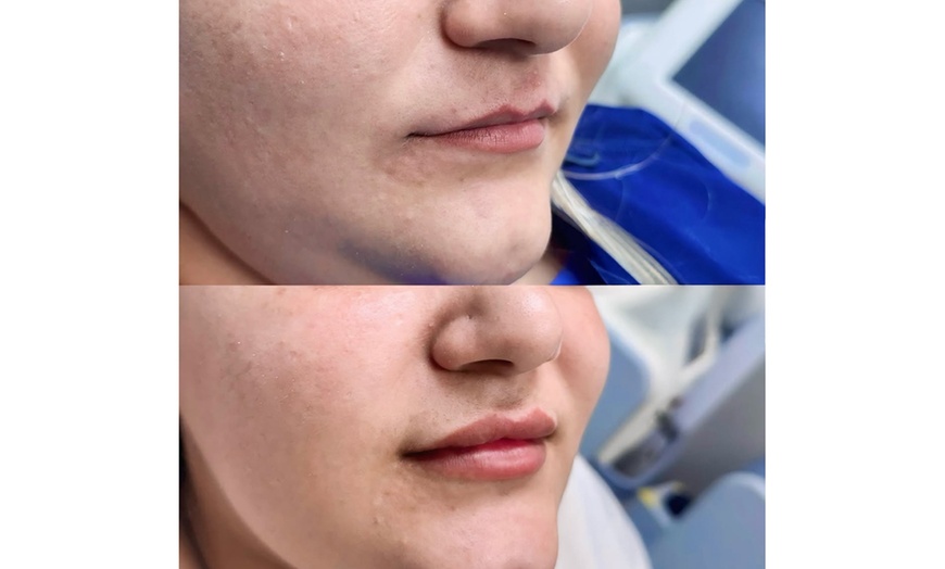 Image 5: Revitalize with One (1.2ml) or Two (2.4mL) Syringes of Revanesse Versa