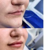 Image 5: Revitalize with One (1.2ml) or Two (2.4mL) Syringes of Revanesse Versa