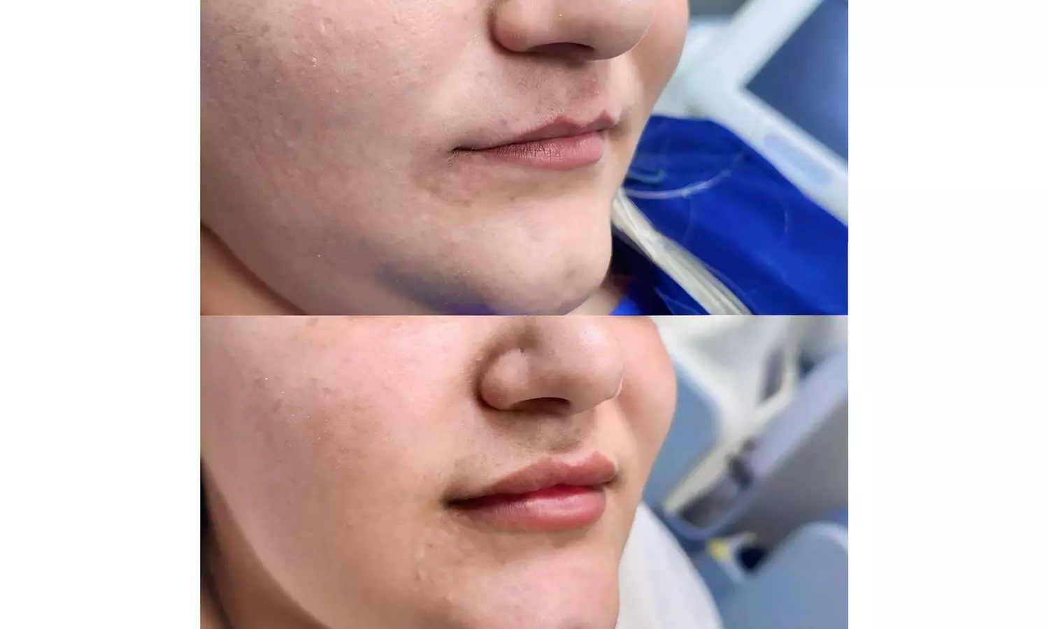 Revitalize with One (1.2ml) or Two (2.4mL) Syringes of Revanesse Versa