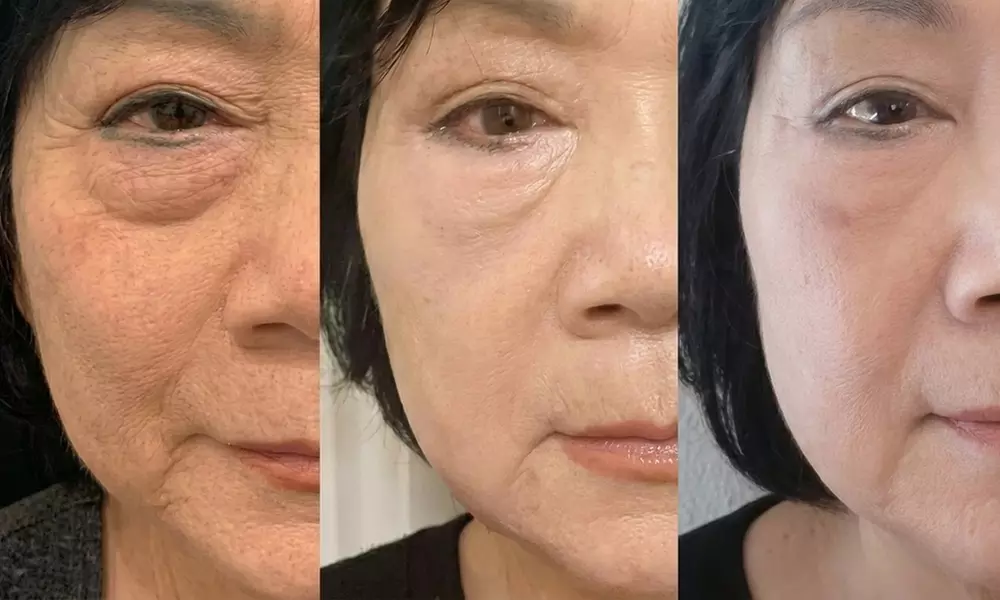 Agnes RF Treatment for Under-Eye Bags & Skin Restoration