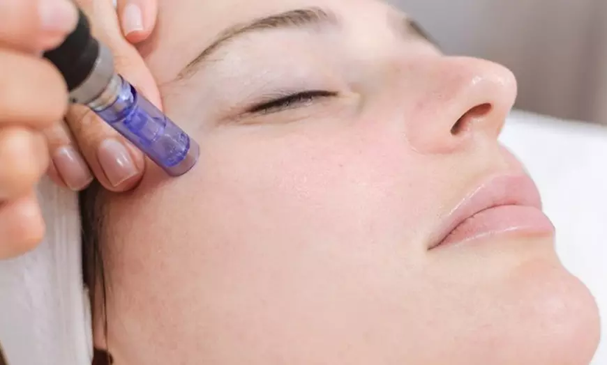 Image 10: Exosomas con dermapen en rostro completo