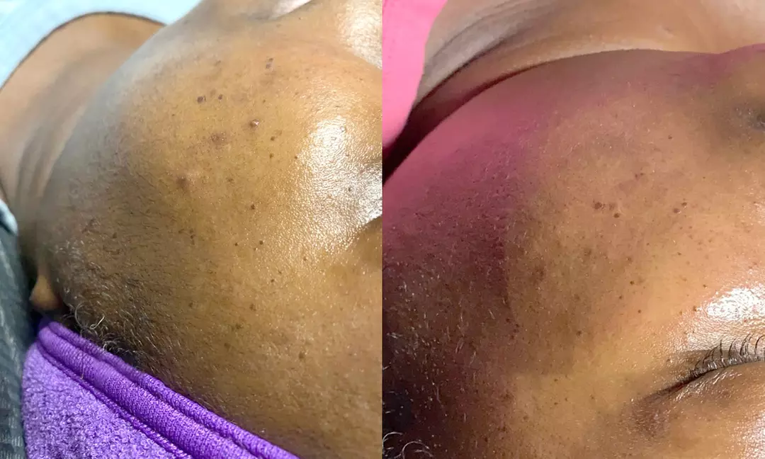 1, 3, or 5 Microdermabrasion Facials w/ LED or High Frequency Therapy