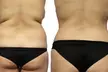 Tone Your Body with One or Two CoolSculpting Treatments at Prime Health Beauty & Medical Practice(Up to 45%Off) - Second Medium