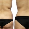 Image 3: Transform Your Body with One or Two CoolSculpting Treatments
