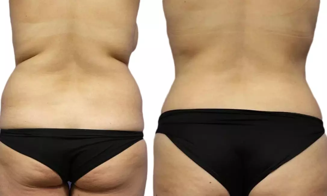Transform Your Body with One or Two CoolSculpting Treatments