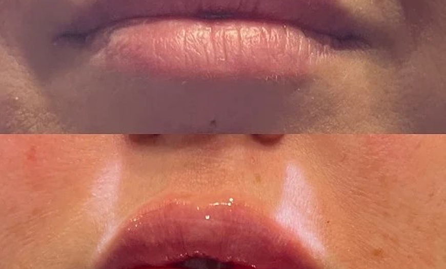 Image 3: Youthful Glow with 20, 30, 40, 60, or 100 Units of Botox Injections