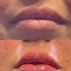 Image 3: Youthful Glow with 20, 30, 40, 60, or 100 Units of Botox Injections