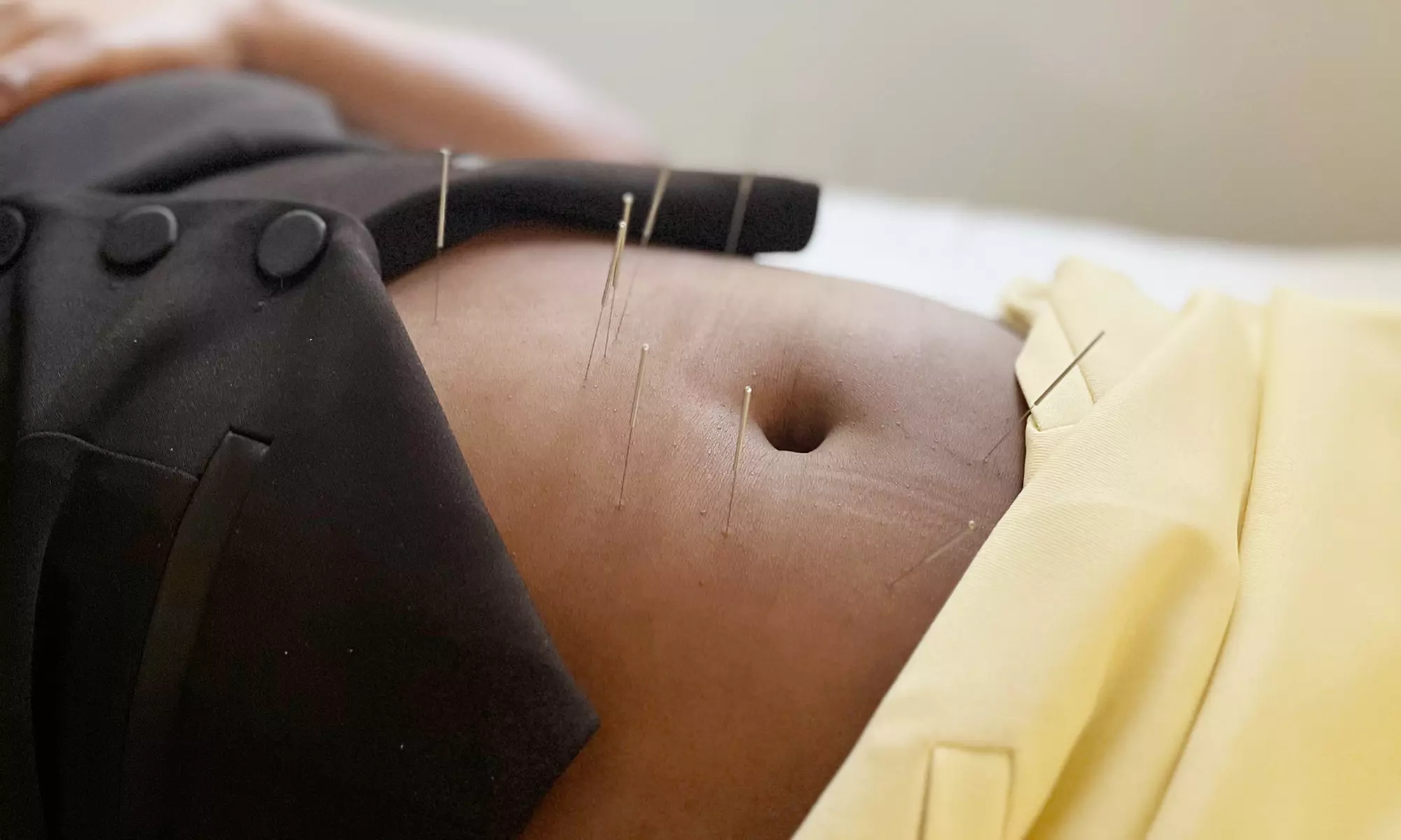 Experience the Benefits of Acupuncture w/ 1, 3 or 5 Sessions at Yoo Balance therapy and wellness (Up to 55% Off) - Second Medium
