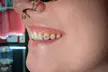 Shine Bright with Tooth Gems at Piercings by Marah (Up to 60% Off) - Second Medium