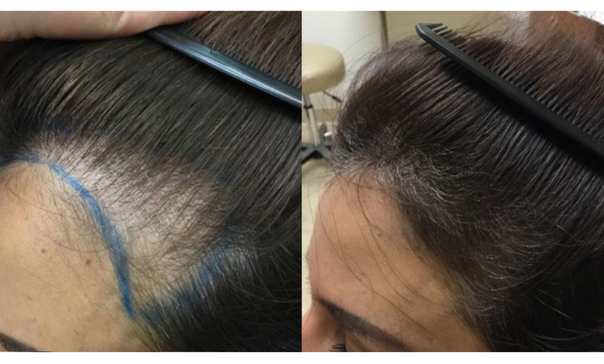 Image 7: Up to 6 Sessions of PRP Medical Hair Restoration at Knightsbridge Medical Center