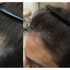 Image 7: Up to 6 Sessions of PRP Medical Hair Restoration at Knightsbridge Medical Center