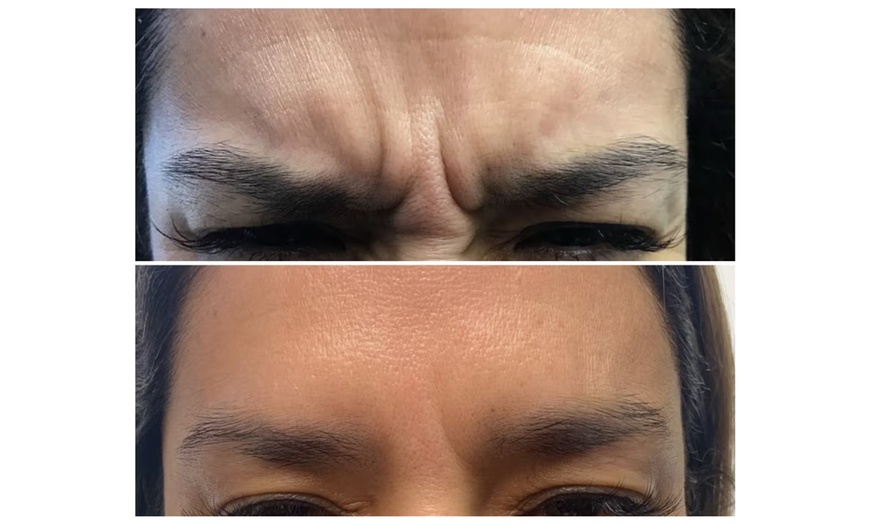 Image 4: Experience a Youthful Look with 20 Units of Botox