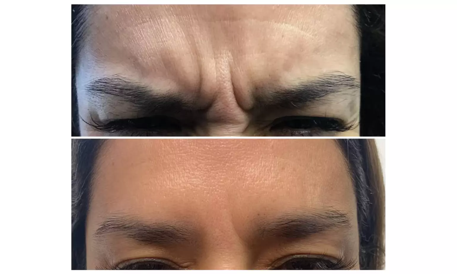 Experience a Youthful Look with 20 Units of Botox