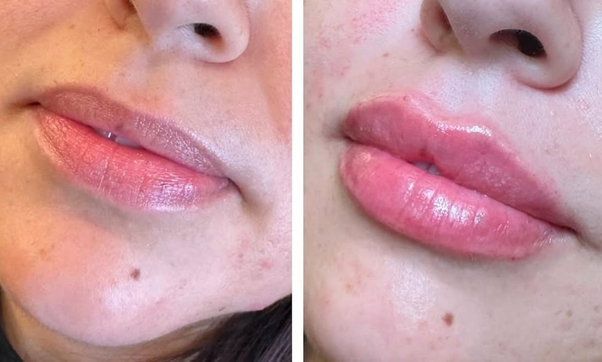 Image 2: Enhance your Beauty with Dermal Filler with Consultation