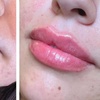 Image 2: Enhance your Beauty with Dermal Filler with Consultation