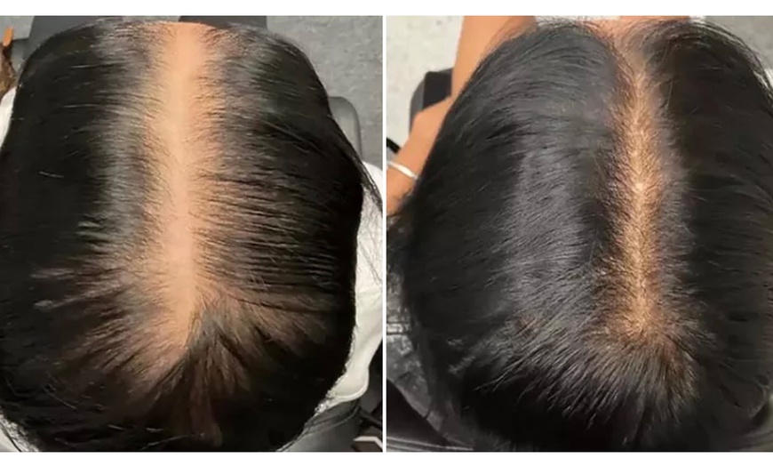 Image 2: Consultation for PRP Hair Restoration Available