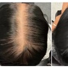 Image 2: Consultation for PRP Hair Restoration Available