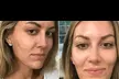 Transform Your Skin: Microneedling with Cryo & Glutathione(Up to 67% Off) - Second Medium