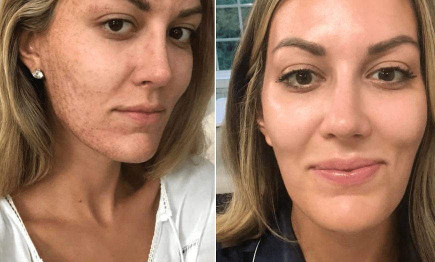 Image 2: Transform Your Skin: Microneedling with Cryo & Glutathione