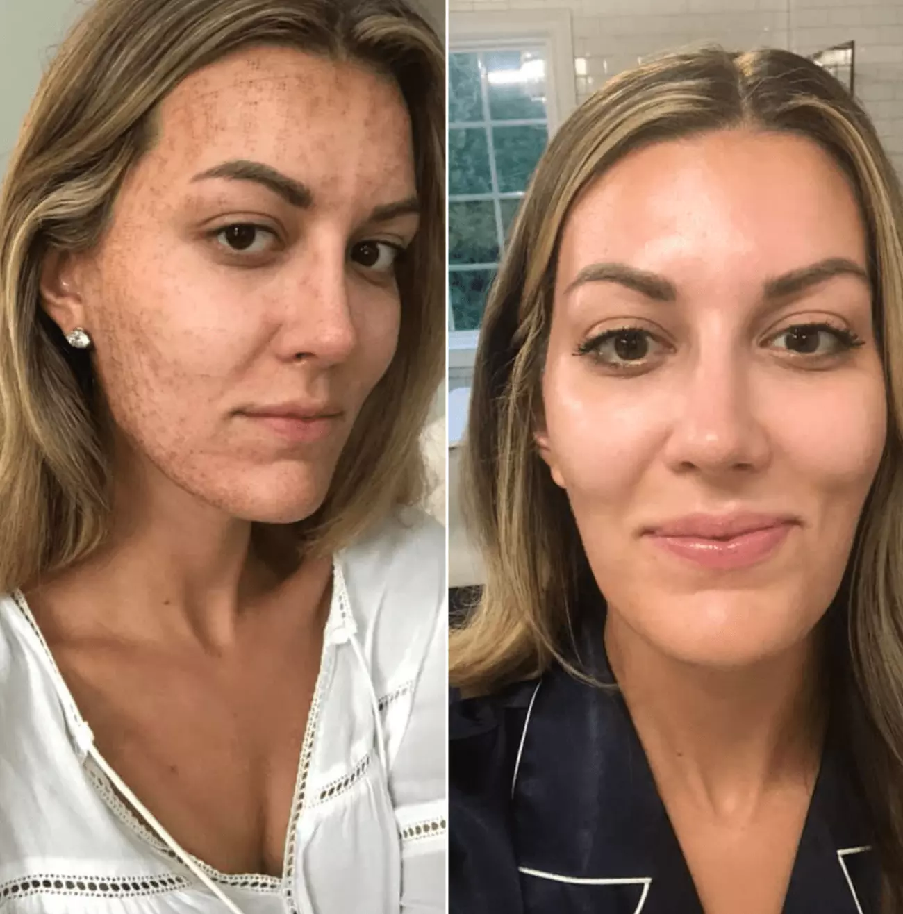 Transform Your Skin: Microneedling with Cryo & Glutathione