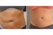 Slim Your Waistline with One, Three, or Five Laser Lipo Sessions - Up to 43% Off at Luxe Renewal Wellness Spa - Second Medium
