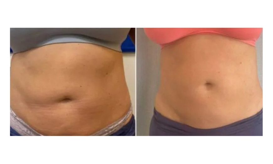 Image 4: One, Three, or Five Laser Lipo Sessions for Waistline