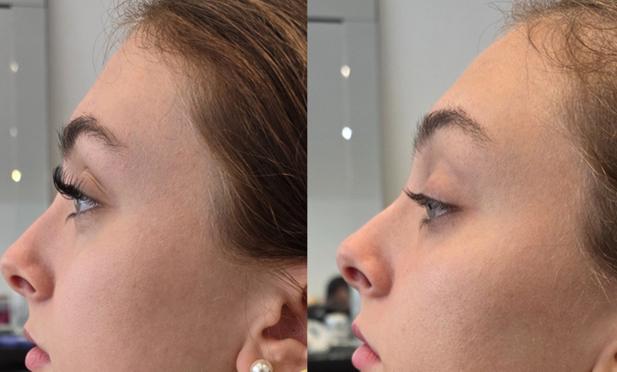 Image 3: Enhance your natural radiance with Dermal Filler