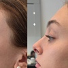 Image 3: Enhance your natural radiance with Dermal Filler