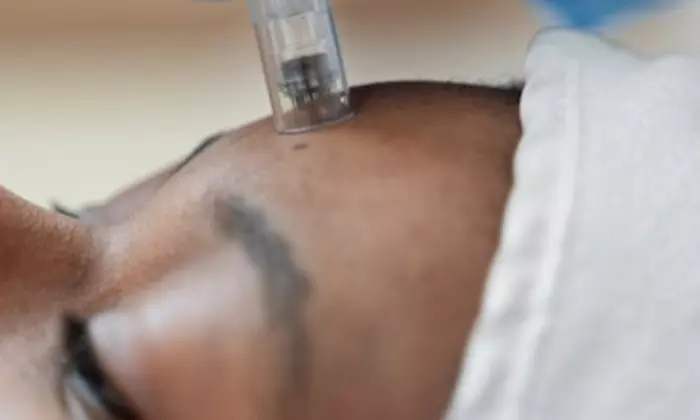 Transform Your Skin with One, Two, or Three Microneedling Sessions