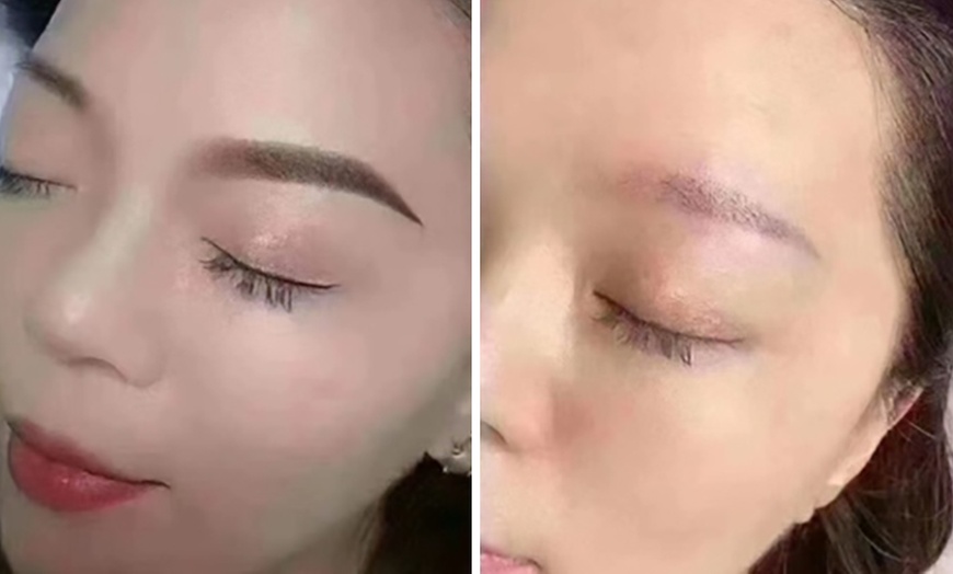 Image 3: 45 Min. Carbon Laser Peeling oder IPL Behandlung nach Wahl für 1 Pers.