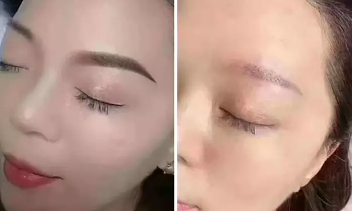 45 Min. Carbon Laser Peeling oder IPL Behandlung nach Wahl für 1 Pers.