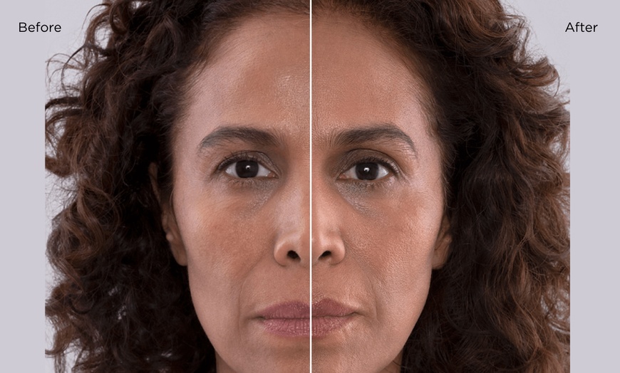 Image 2: Rejuvenate Your Skin with One Vial of Sculptra in Oakland@Truebeauty