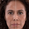 Image 2: Rejuvenate Your Skin with One Vial of Sculptra in Oakland@Truebeauty