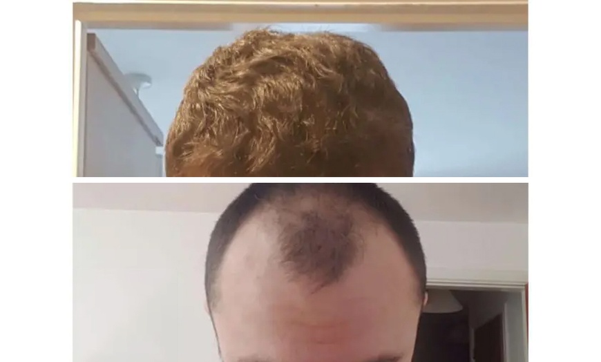 Image 2: Natural-Looking Hair Restoration with Up to 3000-Graft FUE Transplant
