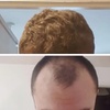 Image 2: Natural-Looking Hair Restoration with Up to 3000-Graft FUE Transplant