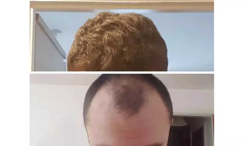 Natural-Looking Hair Restoration with Up to 3000-Graft FUE Transplant