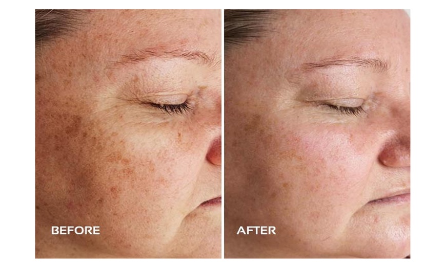 Image 6: Choose Medical Dermalux MD Triwave LED Light Therapy Pak of 10 or 20 