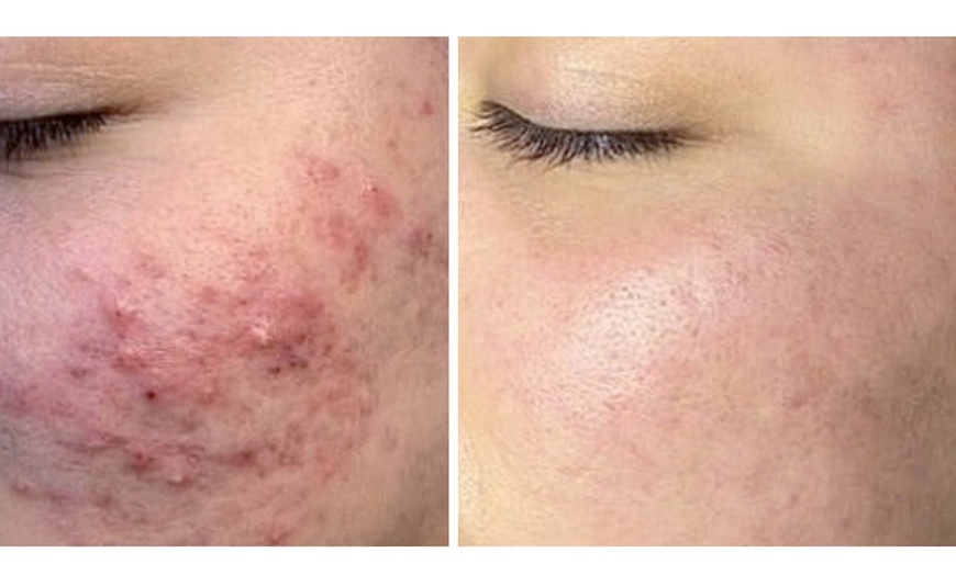 Image 3: Get 1x, 3x, or 5x Chemical Peel Session for Face, Neck & Decolletage