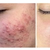 Image 3: Get 1x, 3x, or 5x Chemical Peel Session for Face, Neck & Decolletage
