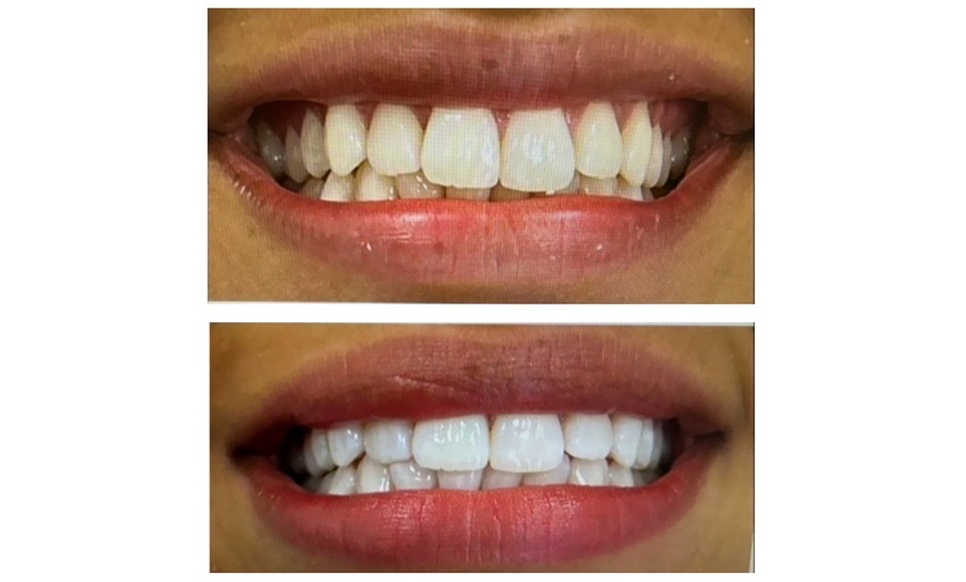 Image 3: Get a Brighter Smile with Phillips Zoom Whitening! Teeth Whitening