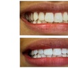 Image 5: Get a Brighter Smile with Phillips Zoom Whitening! Teeth Whitening