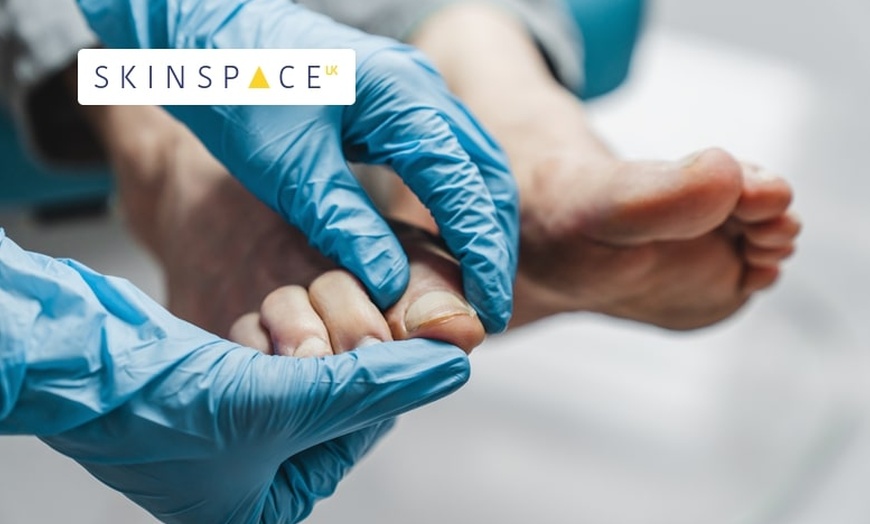 Image 1: Nail Fungal Laser Treatment at SkinSpaceUK – 6 Locations Nationwide