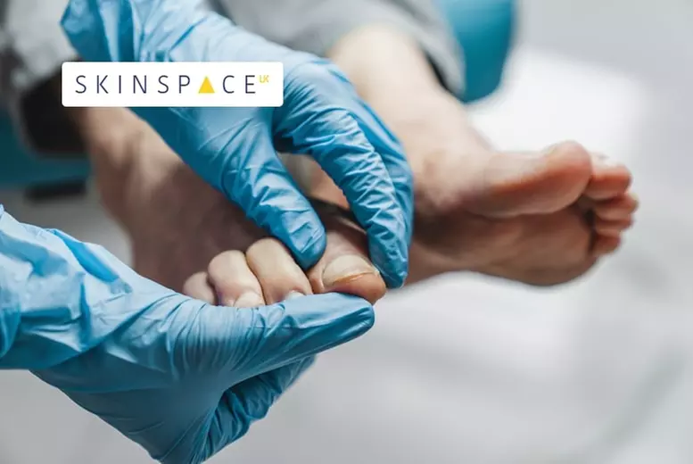 Nail Fungal Laser Treatment at SkinSpaceUK – 6 Locations Nationwide