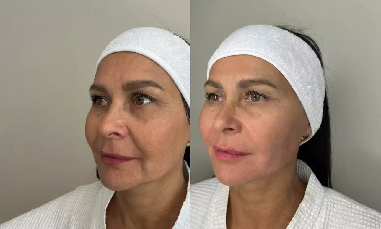 Glow Your Skin with Hydra-Facial 11 Steps - with LED Light Therapy at Humman Skin (Up to 82%Off) - Image 2