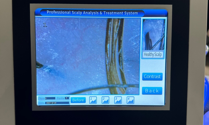 Image 2: Scalp Analysis and Hair Restoration Consultations