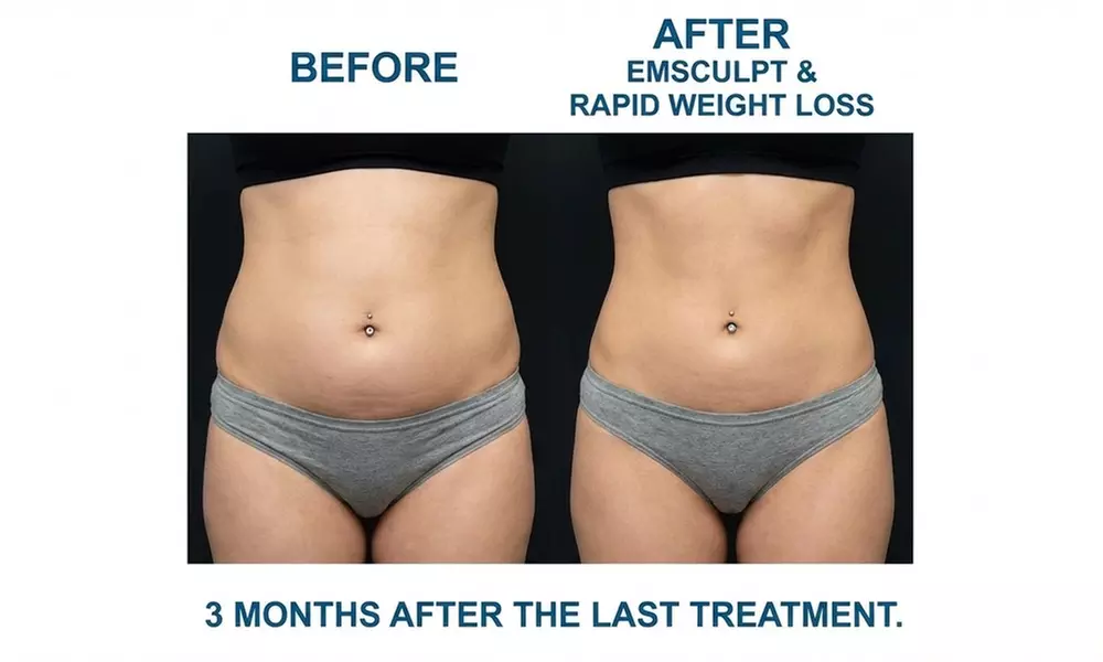 EM Muscle Stimulation Body Sculpting for Abdomen or/& Butt-1 hr/30 Min