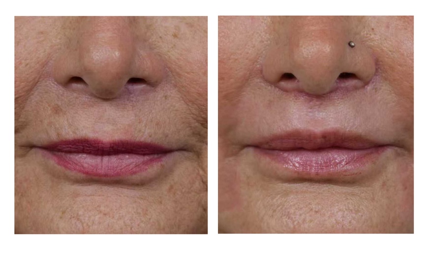 Image 2: 1 or 3 IPL Acne, Melasma, Brown Spots, or Rejuvenation Treatments
